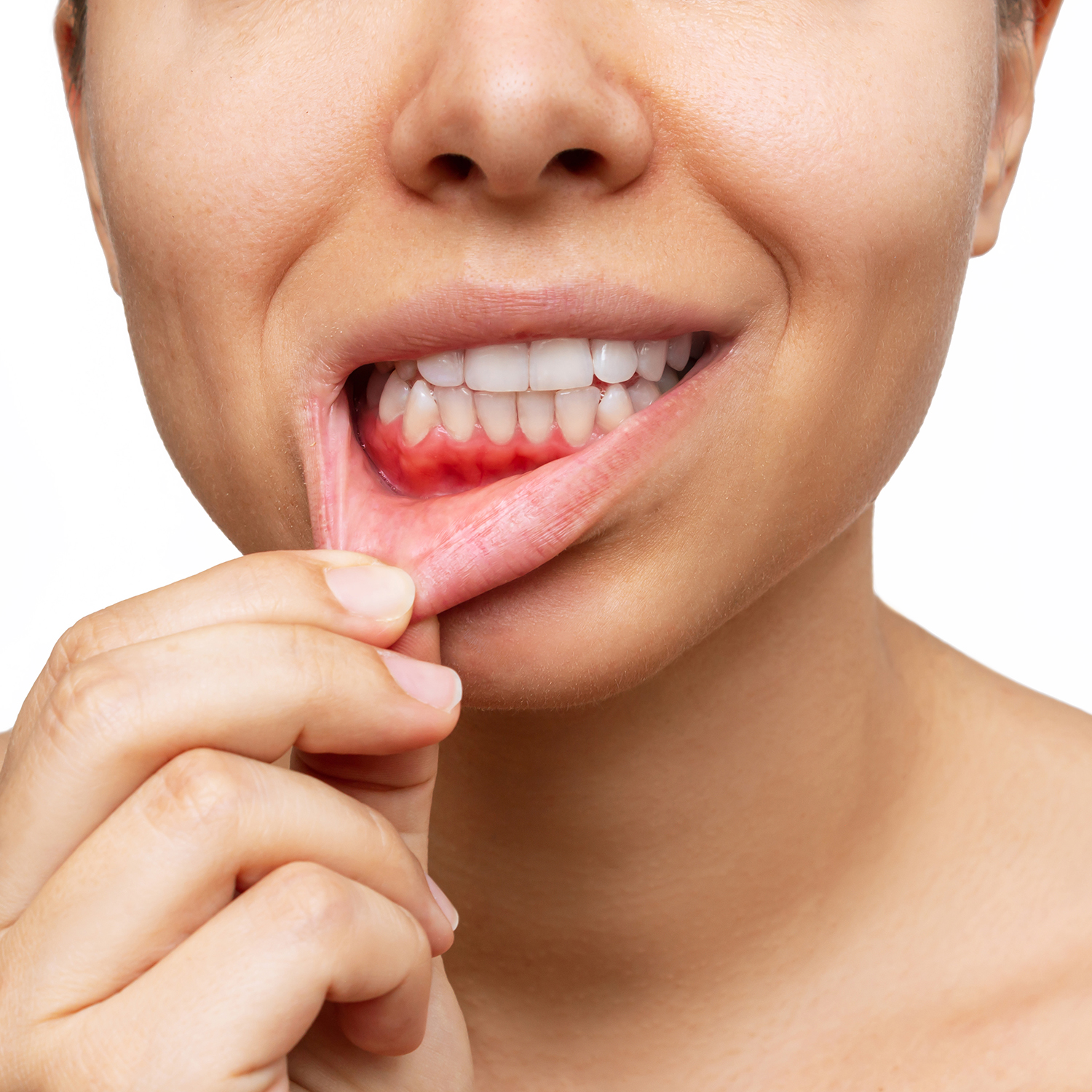 Inflammation des gencives